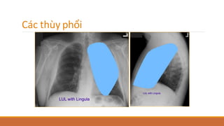 Các thùy phổi
 