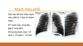 Mạch máu phổi
Giới hạn để nhìn thấy mạch
máu phổi là 1,5cm từ thành
ngực.
KT mạch máu vùng đáy
gấp 2 vùng đỉnh.
Số lượng mạch máu: 1/3
dưới > 1/3 giữa > 1/3 trên
 