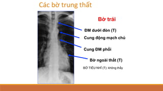 Các bờ trung thất
Bờ trái
ĐM dưới đòn (T)
Cung động mạch chủ
Cung ĐM phổi
Bờ ngoài thất (T)
BỜ TIỂU NHĨ (T): không thấy
 