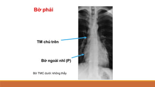 Bờ phải
TM chủ trên
Bờ ngoài nhĩ (P)
Bờ TMC dưới: không thấy
 