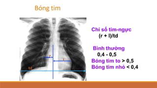 Chỉ số tim-ngực
(r + l)/td
Bình thường
0,4 - 0,5
Bóng tim to > 0,5
Bóng tim nhỏ < 0,4
r
l
td
Bóng tim
 