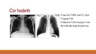 P cao hơn T: 88%, kc#1.5 – 2cm.
P ngang T: 9%
P thấp hơn T: 3% nhưng kc <1cm
Bờ nhẵn đều hoặc lồi phân múi
Cơ hoành
 