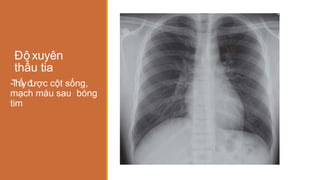 Độ xuyên
thấu tia
-
T
h
ấ
yđ
ược cột sống,
mạch máu sau bóng
tim
 