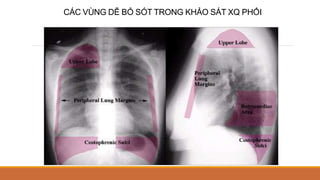 CÁC VÙNG DỄ BỎ SÓT TRONG KHẢO SÁT XQ PHỔI
 