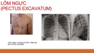 LÕM NGỰC
(PECTUS EXCAVATUM)
Lõm ngực: xương ức lõm, chèn ép
tim và nhu mô phổi
 