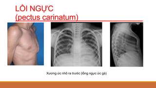 LỒI NGỰC
(pectus carinatum)
Xương ức nhô ra trước (lồng ngực ức gà)
 