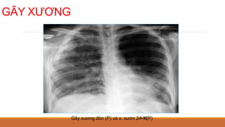 GÃY XƯƠNG
Gãy xương đòn (P) và x. sườn 2


6
(P)
 