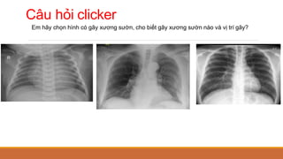 Câu hỏi clicker
Em hãy chọn hình có gãy xương sườn, cho biết gãy xương sườn nào và vị trí gãy?
 