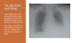 Tia yếu (hình
quá trắng)
-
‐Vòm hoành (T) có thể
không nhìn thấy rõ do
đáy phổi (T) bị mờ 

Giả bệnh lý hoặc ẩn đi
bệnh lý của đáy phổi (T)
-
‐Các mạch máu phổi có
thể sẽ thấy rõ rang, nổi
bật hơn Nhầm với
suy tim sung huyết, xơ
phổi
 