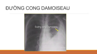 ĐƯỜNG CONG DAMOISEAU
 