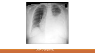 TDMP lượng nhiều
 