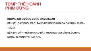 TDMP THỂ HOÀNH
PHIM ĐỨNG
◦ KHÔNG CÓ ĐƯỜNG CONG DAMOISEAU
◦ BÊN (T): ĐÁY PHỔI CAO, TĂNG KC BÓNG HƠI DẠ DÀY-ĐÁY PHỔI >
1,5CM
◦ BÊN (P): ĐÁY PHỔI (P) CAO BẤT THƯỜNG VỚI ĐỈNH LỆCH RA
NGOÀI ĐƯỜNG TRUNG ĐÒN
 