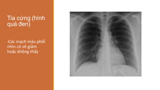Tia cứng (hình
quá đen)
-
‐Các mạch máu phổi
nhìn có vẻ giảm
hoặc không thấy
 