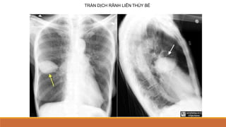 TRÀN DỊCH RÃNH LIÊN THÙY BÉ
 