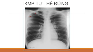 TKMP TƯ THẾ ĐỨNG
 