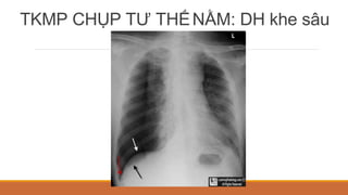 TKMP CHỤP TƯ THẾNẰM: DH khe sâu
 