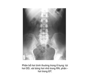 Phân bố hơi bình thường trong ổ bụng: túi
hơi DD, vài bóng hơi nhỏ trong RN, phân -
hơi trong ĐT.
 