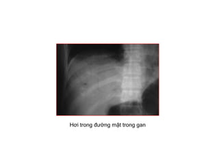 Hơi trong đường mật trong gan
 