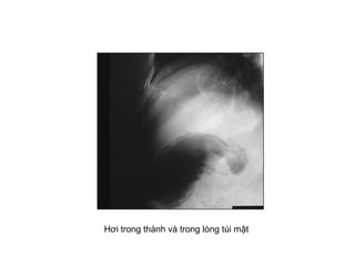 Hơi trong thành và trong lòng túi mật
 