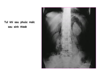 Tuï khí sau phuùc maïc
sau sinh thieát
 