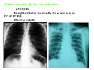 Chẩn đoán phân biệt liềm hơi dưới hoành:
-Túi hơi dạ dày
-Mô phổi bình thường nằm giữa đáy phổi và cung sườn sát
trên với đáy phổi
-Hội chứng Chilaiditi
 