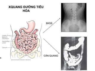 XQUANG ĐƯỜNG TIÊU
HÓA
BKSS
CẢN QUANG
 