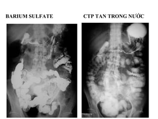 BARIUM SULFATE CTP TAN TRONG NƯỚC
 