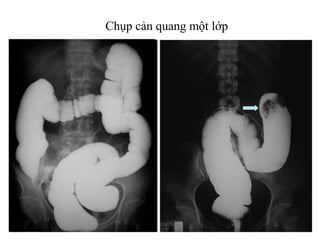 Chụp cản quang một lớp
 