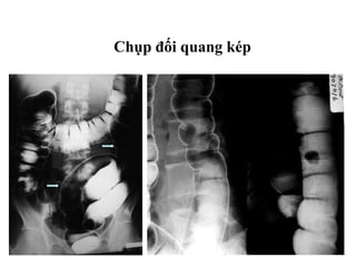Chụp đối quang kép
 