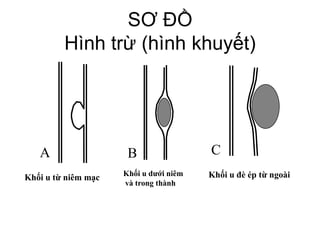 Khối u từ niêm mạc
A
Khối u dưới niêm
và trong thành
B
Khối u đè ép từ ngoài
C
SƠ ĐỒ
Hình trừ (hình khuyết)
 
