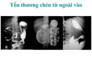 Tổn thương chèn từ ngoài vào
MASS
 