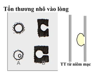 Tổn thương nhô vào lòng
A B TT từ niêm mạc
 