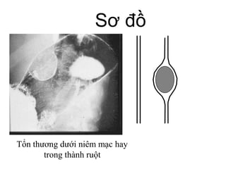 Tổn thương dưới niêm mạc hay
trong thành ruột
Sơ đồ
 