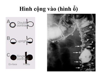 Hình cộng vào (hình ổ)
A
B
Single
contrast
Double
contrast
upright
C
En-face Profile
 