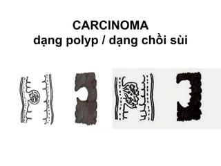 CARCINOMA
dạng polyp / dạng chồi sùi
 