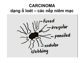 CARCINOMA
dạng ổ loét – các nếp niêm mạc
 