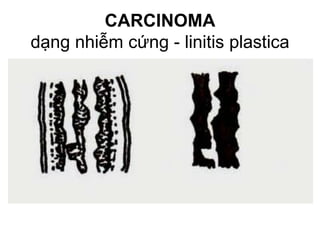 CARCINOMA
dạng nhiễm cứng - linitis plastica
 