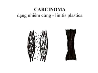 CARCINOMA
dạng nhiễm cứng - linitis plastica
 
