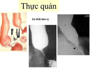 Thực quản
Co thắt tâm vị
 