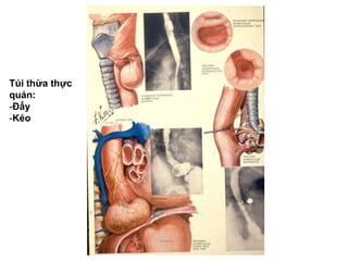 Túi thừa thực
quản:
-Đẩy
-Kéo
 
