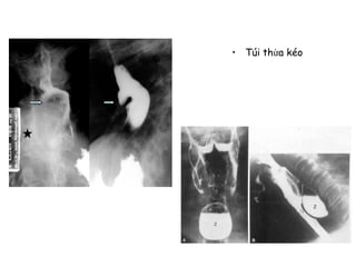 THORACIC DIVERTICULUM
• Túi thừa kéo
 