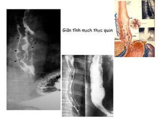 Giãn tĩnh mạch thực quản
 