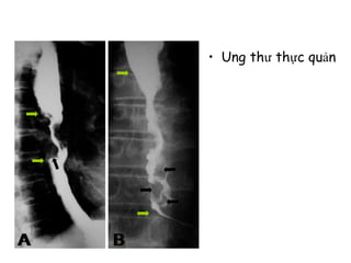 • Ung thư thực quản
 