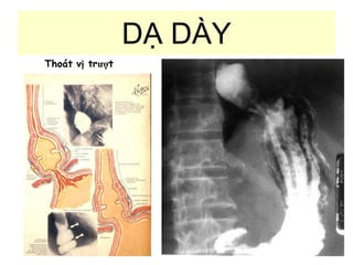 DẠ DÀY
Thoát vị trượt
 