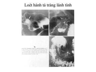 Loét hành tá tràng lành tính
 
