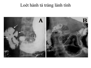 Loét hành tá tràng lành tính
 