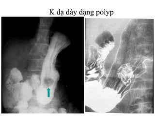 K dạ dày dạng polyp
 
