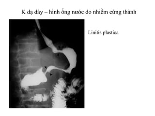 K dạ dày – hình ống nước do nhiễm cứng thành
Linitis plastica
 