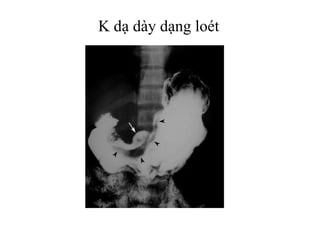 K dạ dày dạng loét
 
