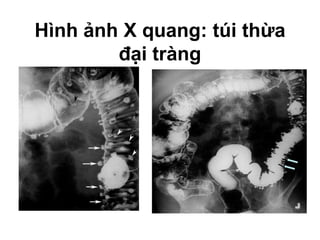 Hình ảnh X quang: túi thừa
đại tràng
 
